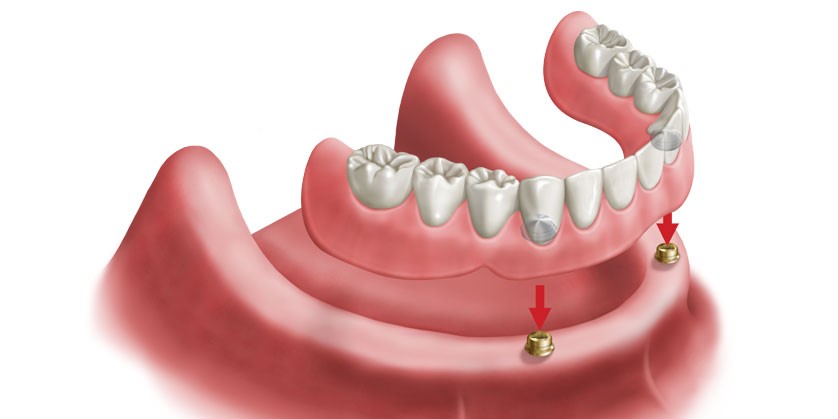 Young Dentures Before And After Fairfield PA 17320